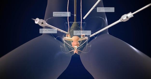 Are surgical clips left in after hysterectomy? 