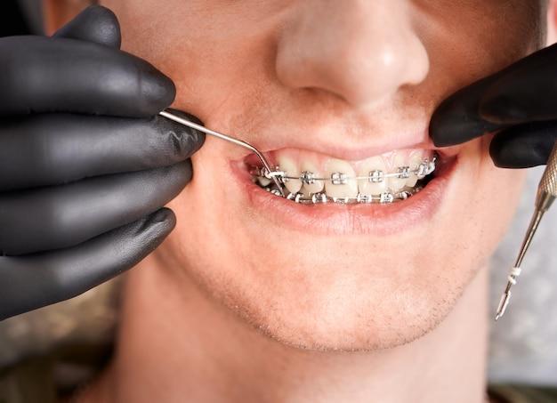 Are you supposed to eat with rubber bands on your braces? 