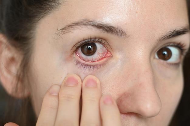 What happens if I get hydraulic fluid in my eye? 