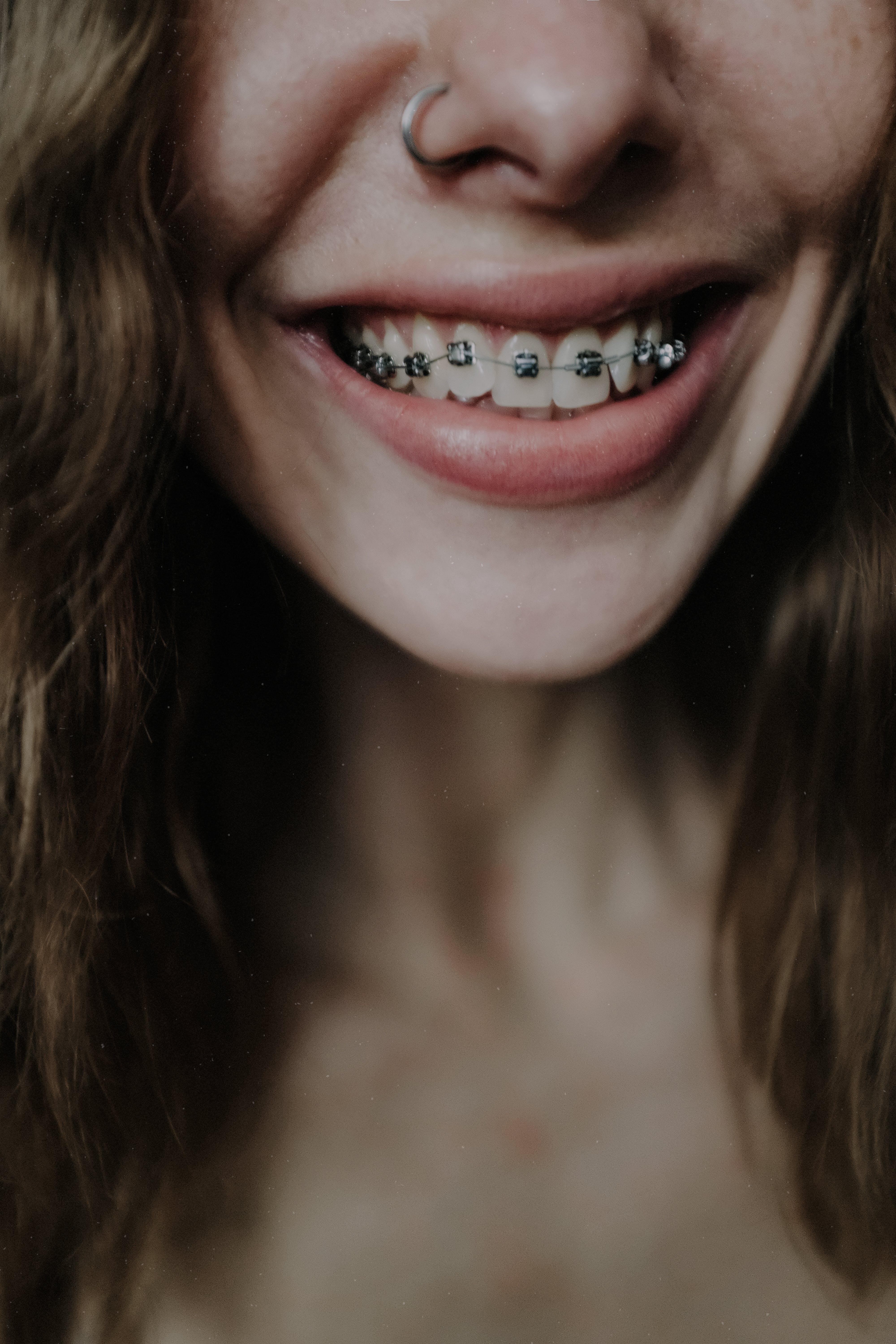Do braces make you look more attractive? 
