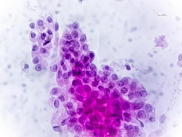 Can a man test negative for trichomoniasis and still have it? 