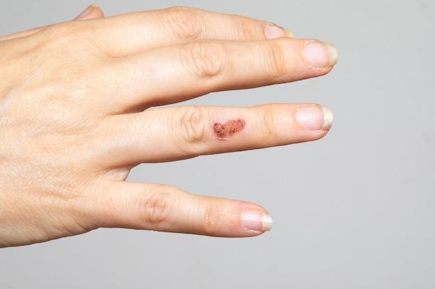 Can animals catch impetigo from humans? 