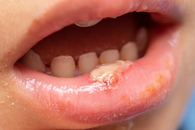 Can you get mouth ulcers from vaping? 