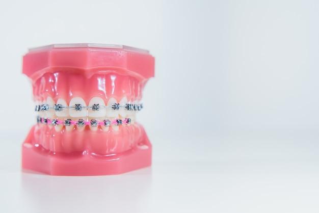 Can you buy fake braces? 