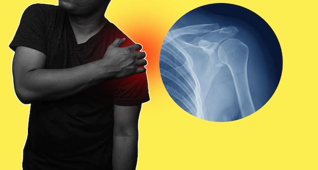 Can you drive with a fractured metatarsal? 