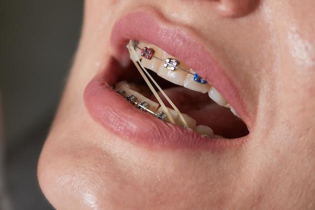 Can you get braces with a flipper tooth? 