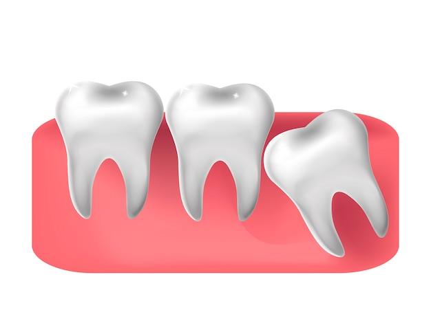 Can you go to school after getting wisdom teeth pulled? 