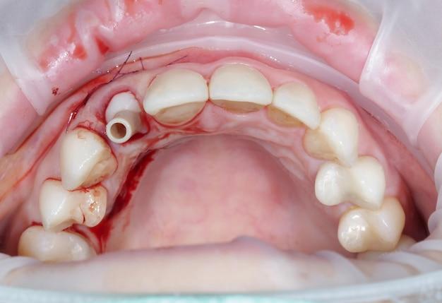 Can you go to school after getting wisdom teeth pulled? 