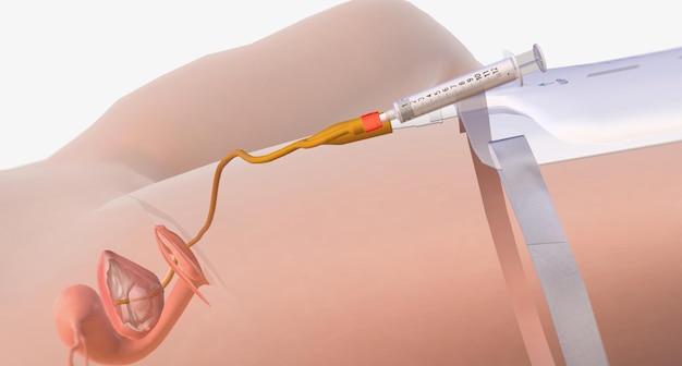 Do you get yeast infections after hysterectomy? 