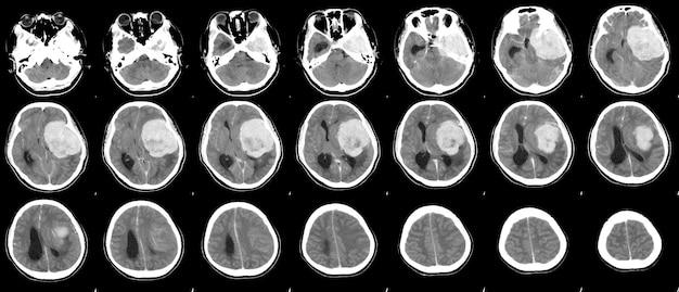 Does IV contrast have side effects? 