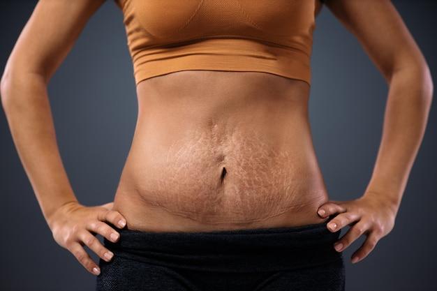 How long after tummy tuck can I stand up straight? 
