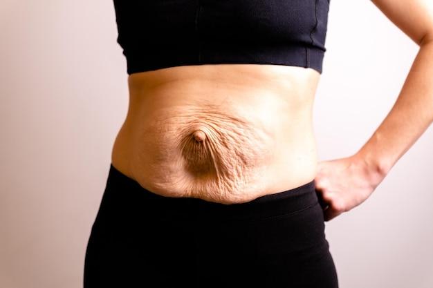 How long does it take for swelling to go down after umbilical hernia surgery? 