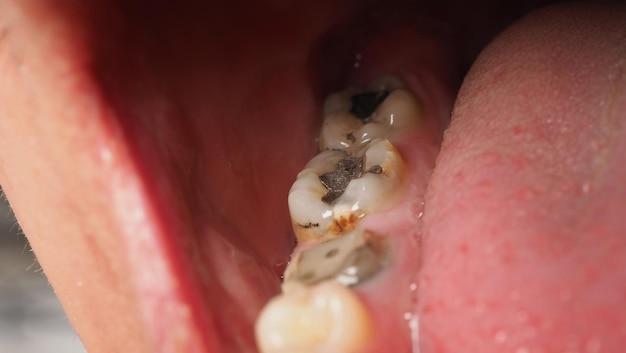 How long does temporary dental cement last? 