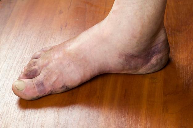 How long does your ankle stay swollen after a fracture? 