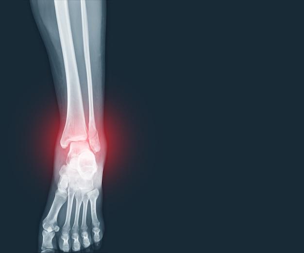 How long does your ankle stay swollen after a fracture? 