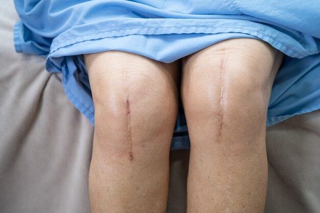 How long should you take aspirin after knee surgery? 