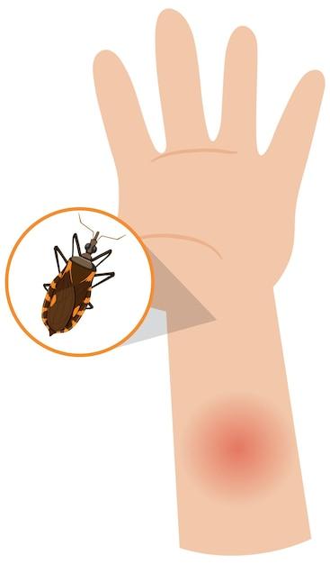 How many times can one flea bite you? 