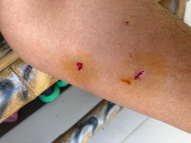 How many times can one flea bite you? 