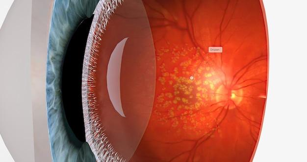 How much does laser photocoagulation cost? 