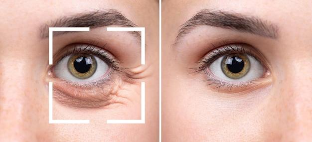 How can I clean my eyelashes after Lasik? 