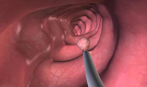 How do you get rid of air in your stomach after a colonoscopy? 