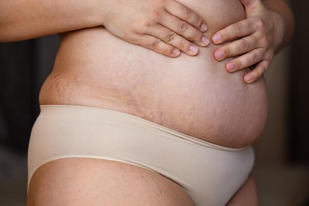 Is it normal to gain weight after stopping birth control? 
