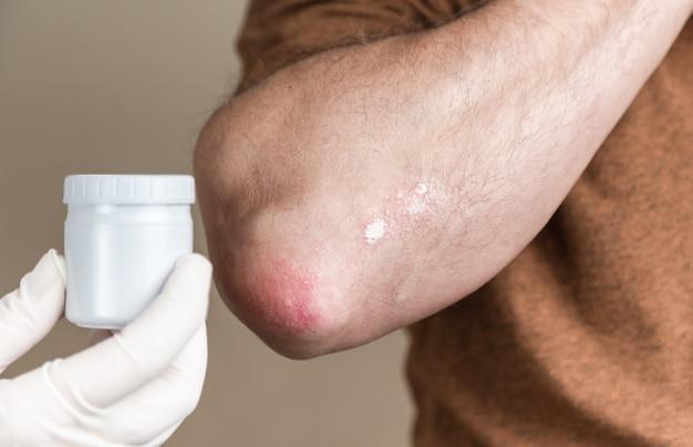 Is Silver Cream good for eczema? 