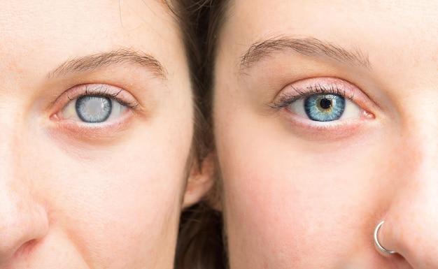 What can you not do after retinal detachment surgery? 