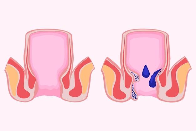 Should I push my hemorrhoid back in? 