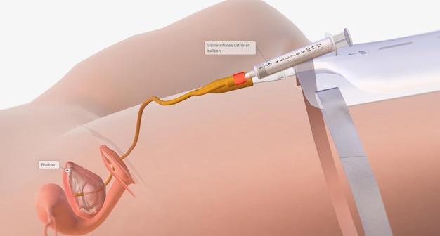Should I take calcium after hysterectomy? 