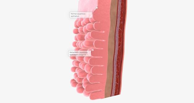 What is squamous mucosa? 