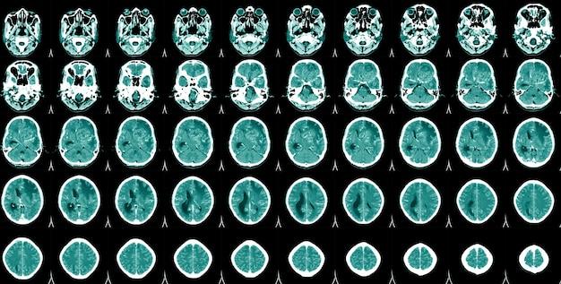 Why is the left side of my head pulsating? 