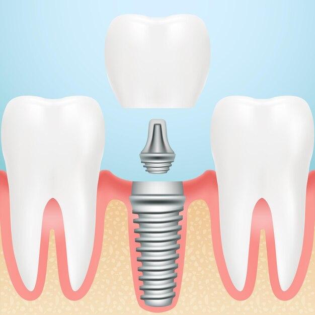What is the dental code for Recement crown? 