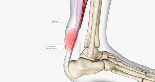 What muscles insert by calcaneal tendon? 