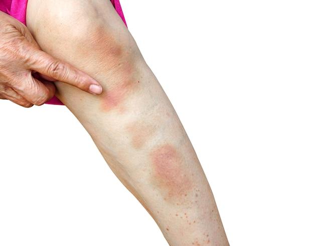 Why is my poison ivy spreading all over my body? 