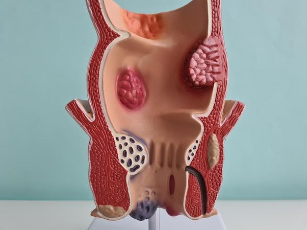 Will they remove hemorrhoids during colonoscopy? 